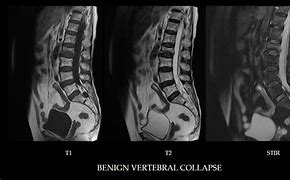 Image result for Vertebral Collapse