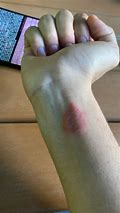 Image result for Apple Watch Strap Allergy