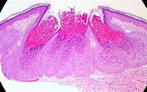 Image result for Molluscum Contagiosum Pathology