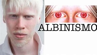 Image result for albinizmo
