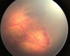 Image result for Retinopathy