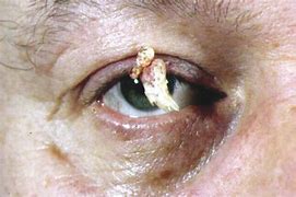 Image result for Verrucous Wart Eyelid