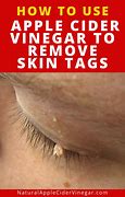 Image result for Removing Skin Tags On Eyelid