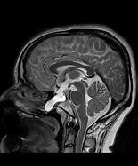 Image result for Different Cranial Meningocele