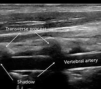 Image result for Vertebral Artery Ultrasound