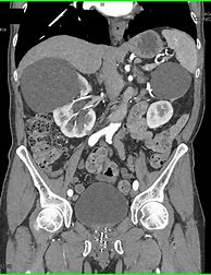 Image result for Cyst in Kedney