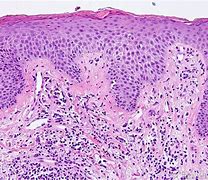 Image result for Eczema Under Microscope