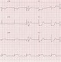 Image result for post-MI ECG