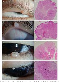 Image result for Molluscum Contagiosum around Eye