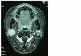Image result for Parotid Cyst Ultrasound