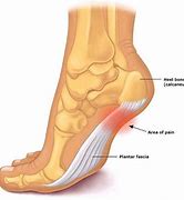 Image result for Foot Pain Plantar Fasciitis