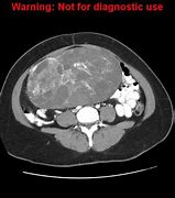 Image result for Ovarian Cancer Tumor Size