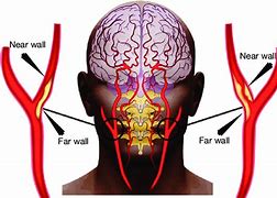 Image result for Occlusion and Stenosis of Left Carotid Artery