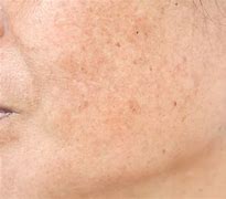 Image result for Skin Discoloration On Face