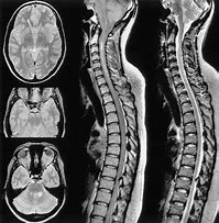 Image result for Full Spine MRI