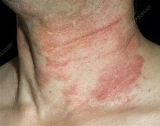 Image result for Baby Eczema Neck