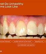 Image result for Thin Gums