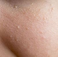 Image result for Flesh-Colored Skin Bumps On Face