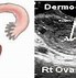 Image result for 4 Cm Cyst On Ovary