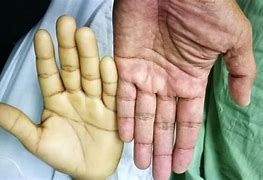 Image result for Anaemia Pallor