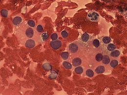 Image result for Indrademal Nodules Scritem