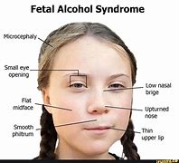 Image result for Small Head Syndrome Microcephaly