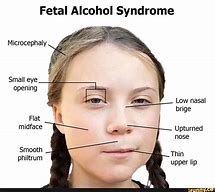 Image result for Microcephaly Eyes