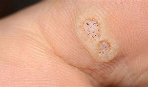 Image result for Papilloma On Foot
