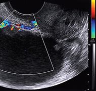 Image result for Ovarian Cancer Ultrasound
