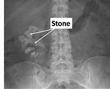 Image result for Kidney Stone Look Like