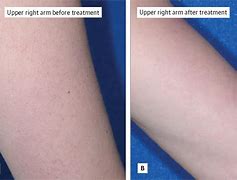 Image result for Keratosis Pilaris Removal