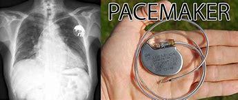 Image result for pacemakers