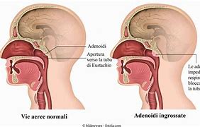 Image result for adenoidei