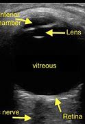 Image result for A Scan Ultrasound Eye