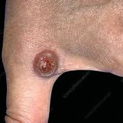 Image result for ORF Skin Lesion