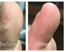 Image result for Wart Treatment Amiqualid