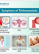 Image result for Trichomoniasis Symptoms