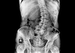 Image result for Spina Bifida Posterior Rachischisis