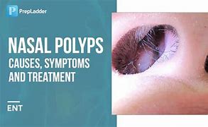 Image result for Nasal Polyps Cancer Symptoms