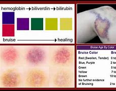 Image result for Colors of Bruises Healing