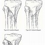 Image result for Cortex Screws