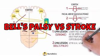 Image result for Bell's Palsy vs Stroke Face