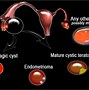 Image result for Ovarian Cyst Classification Ultrasound