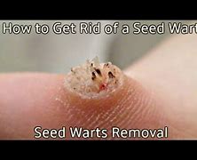 Image result for Seed Wart Finger