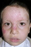 Image result for Fungal Skin Infections Photos
