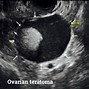 Image result for Teratoma On Ultrasound