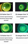 Image result for Contact Lens Fitting