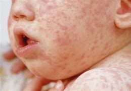 Image result for Viral Rashes On Babies