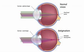 Image result for Optical Astigmatism