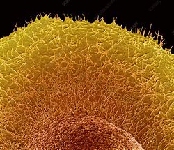 Image result for Colorectal Cancer Cell Sem